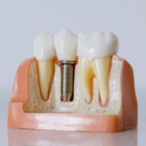 7 Signs that You Need an Implant Dentist in Newark