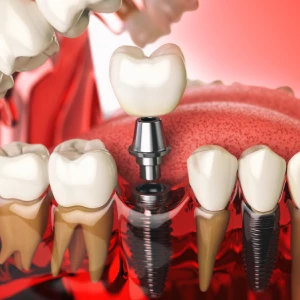 How Extraction in Newark Supports Healthy Dental Implants